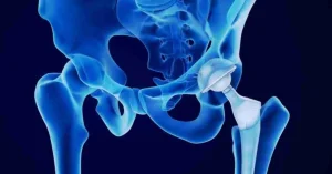 Total Hip Replacement